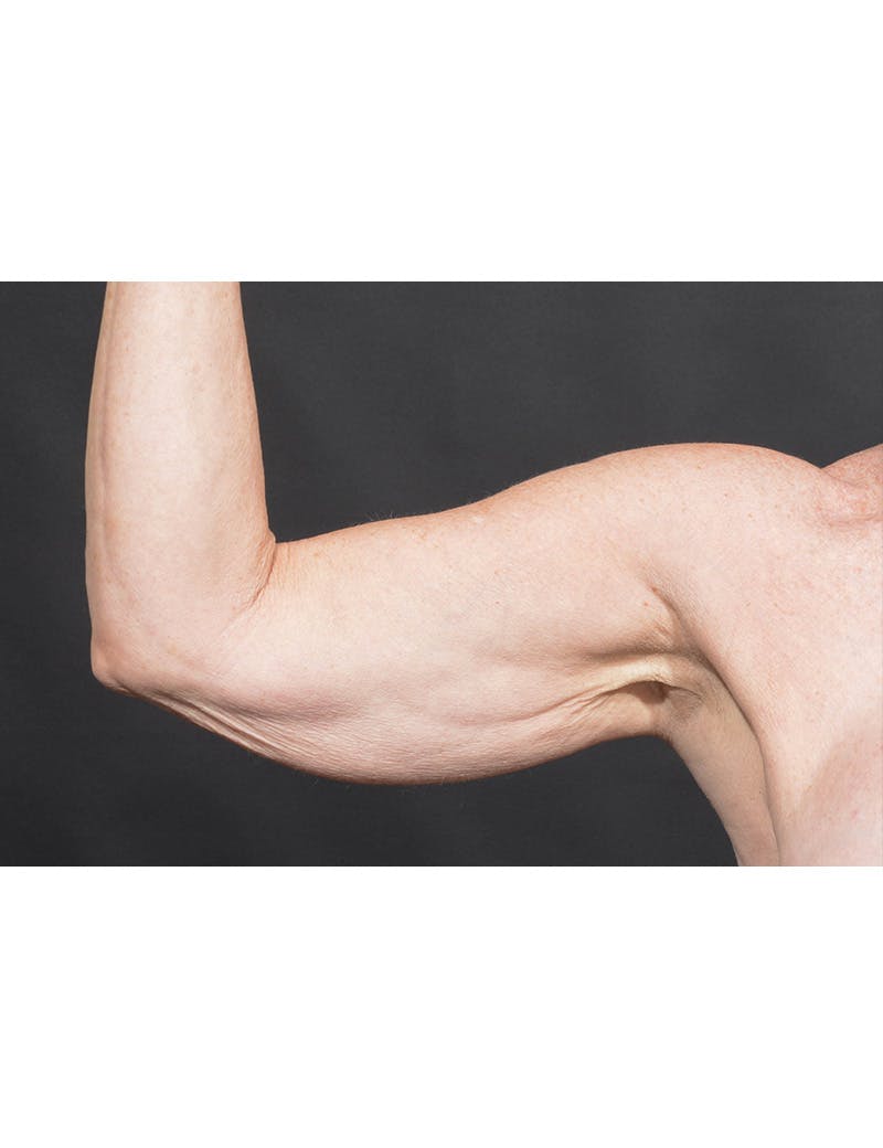 Arm Lift Before & After Gallery - Patient 368505 - Image 1