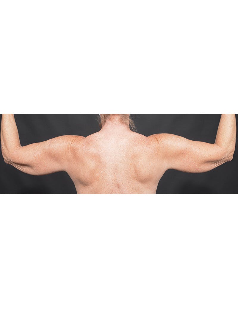 Arm Lift Before & After Gallery - Patient 368505 - Image 3