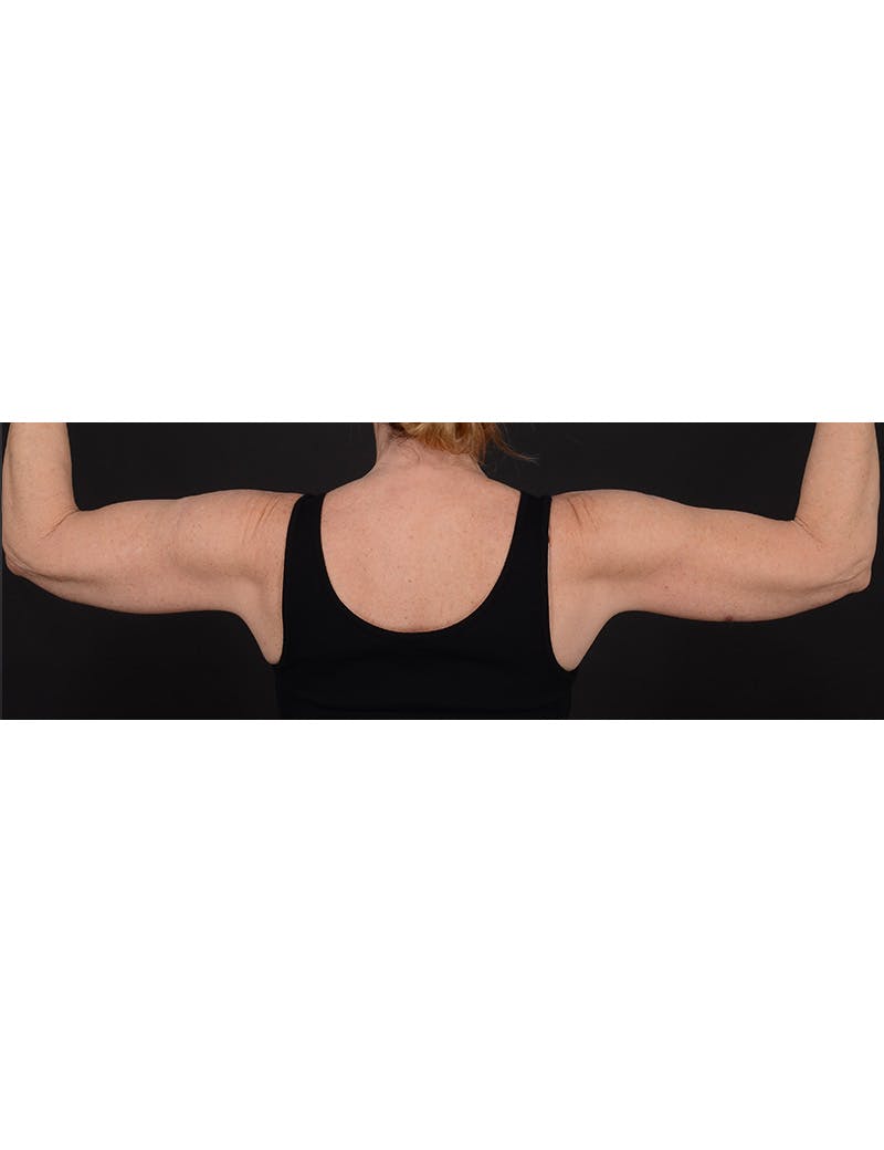 Arm Lift Before & After Gallery - Patient 368505 - Image 4