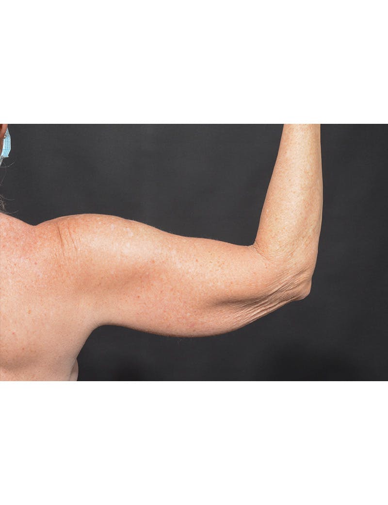 Arm Lift Before & After Gallery - Patient 368505 - Image 5