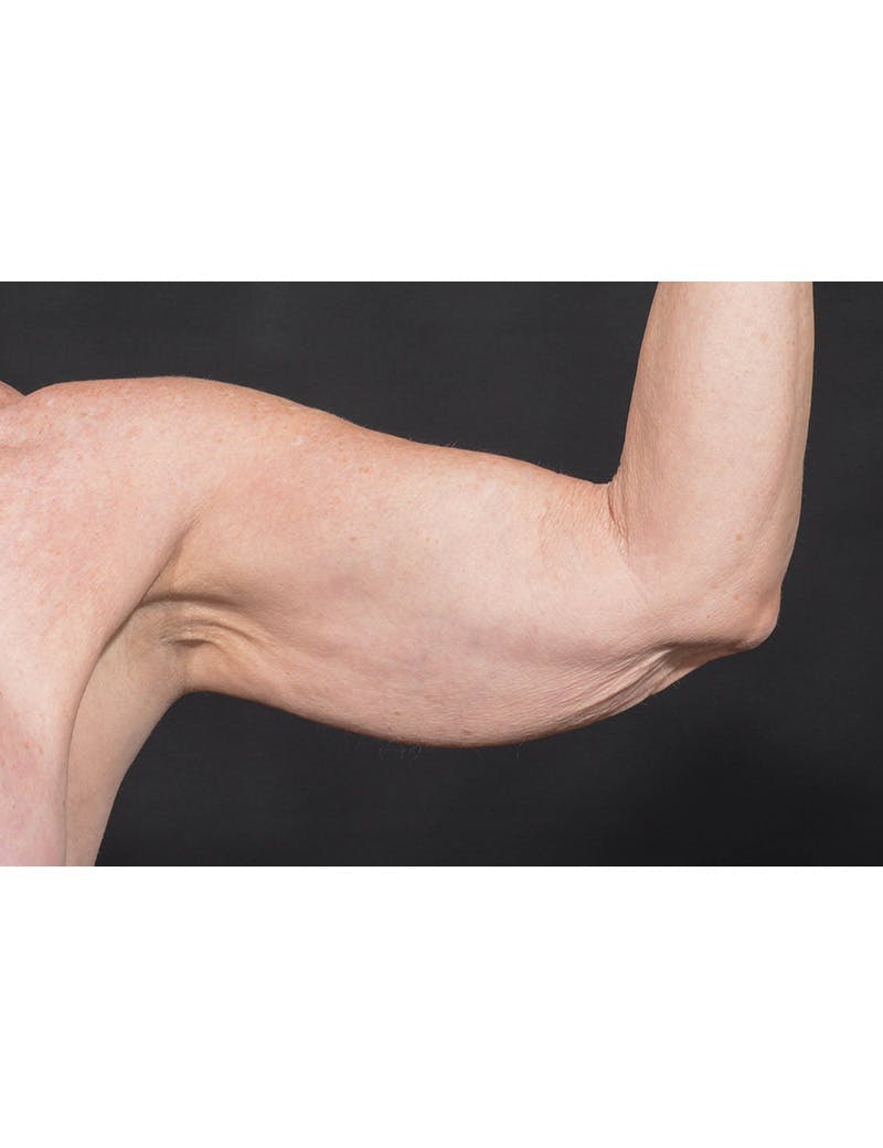 Arm Lift Before & After Gallery - Patient 368505 - Image 7