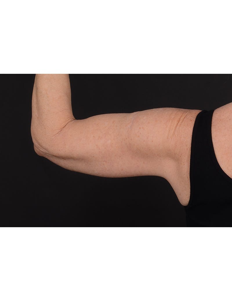 Arm Lift Before & After Gallery - Patient 368505 - Image 10