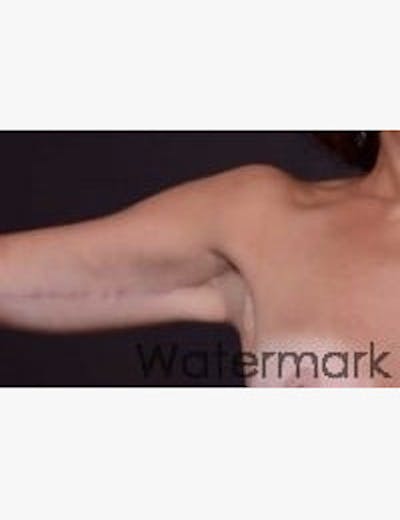 Arm Lift Before & After Gallery - Patient 378864 - Image 2