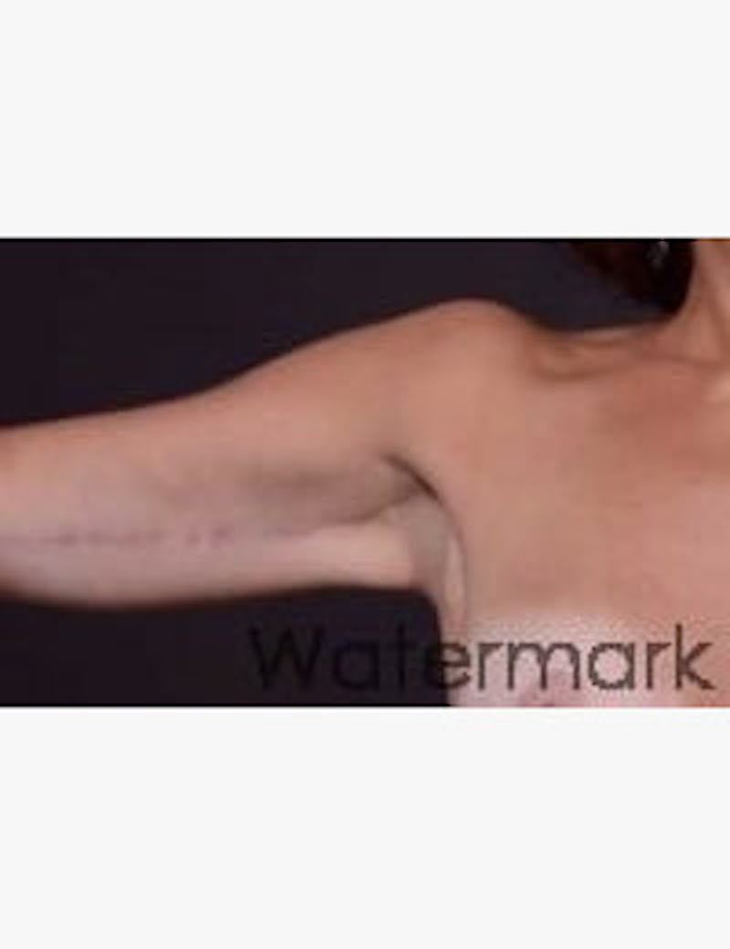 Arm Lift Before & After Gallery - Patient 378864 - Image 2