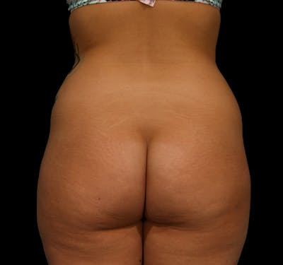Brazilian Butt Augmentation Before & After Gallery - Patient 376641 - Image 1