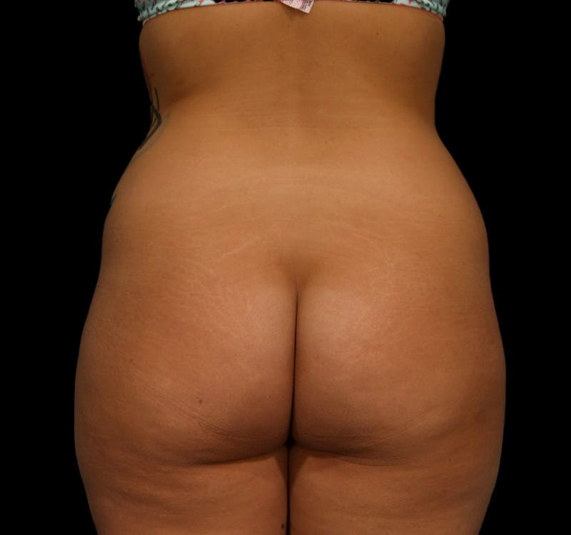 Brazilian Butt Augmentation Before & After Gallery - Patient 376641 - Image 1