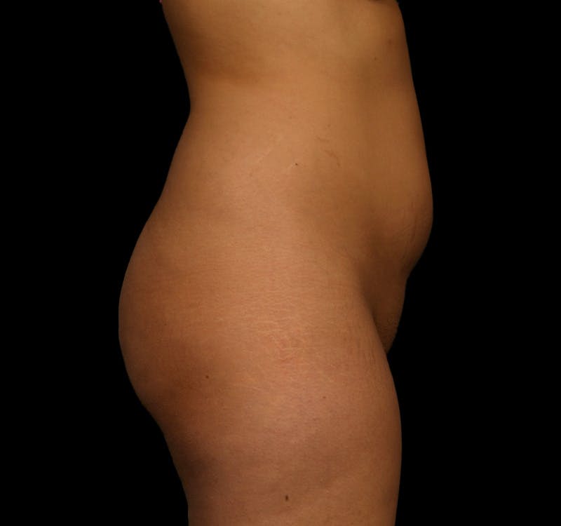 Brazilian Butt Augmentation Before & After Gallery - Patient 376641 - Image 5