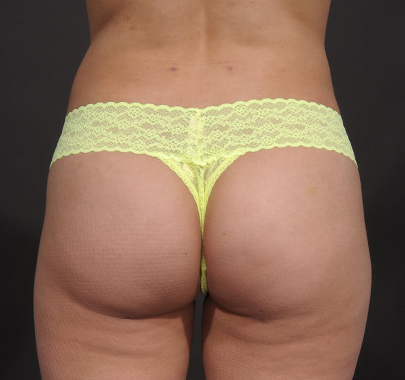 Brazilian Butt Augmentation Before & After Gallery - Patient 214722 - Image 2