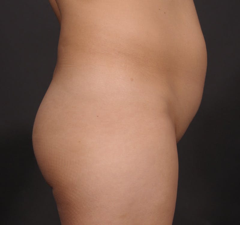 Brazilian Butt Augmentation Before & After Gallery - Patient 214722 - Image 5