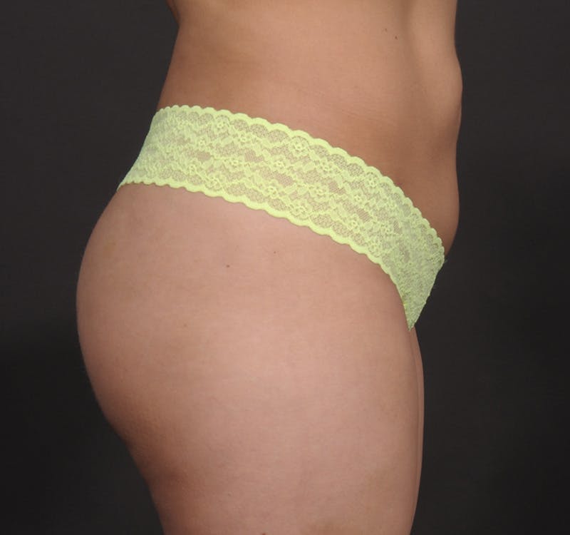 Brazilian Butt Augmentation Before & After Gallery - Patient 214722 - Image 6