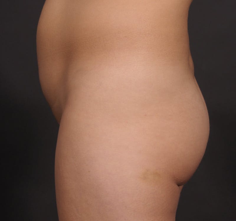 Brazilian Butt Augmentation Before & After Gallery - Patient 214722 - Image 9