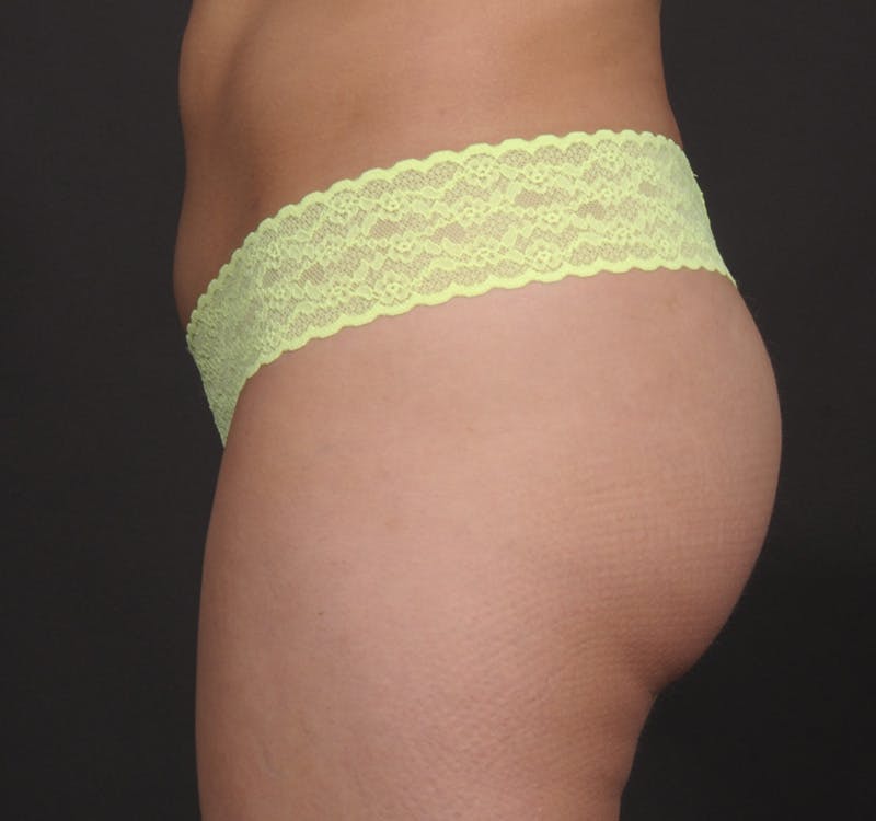 Brazilian Butt Augmentation Before & After Gallery - Patient 214722 - Image 10