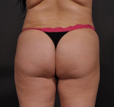 Brazilian Butt Augmentation Before & After Gallery - Patient 549470 - Image 2