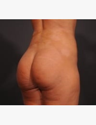 Brazilian Butt Augmentation Before & After Gallery - Patient 545186 - Image 2
