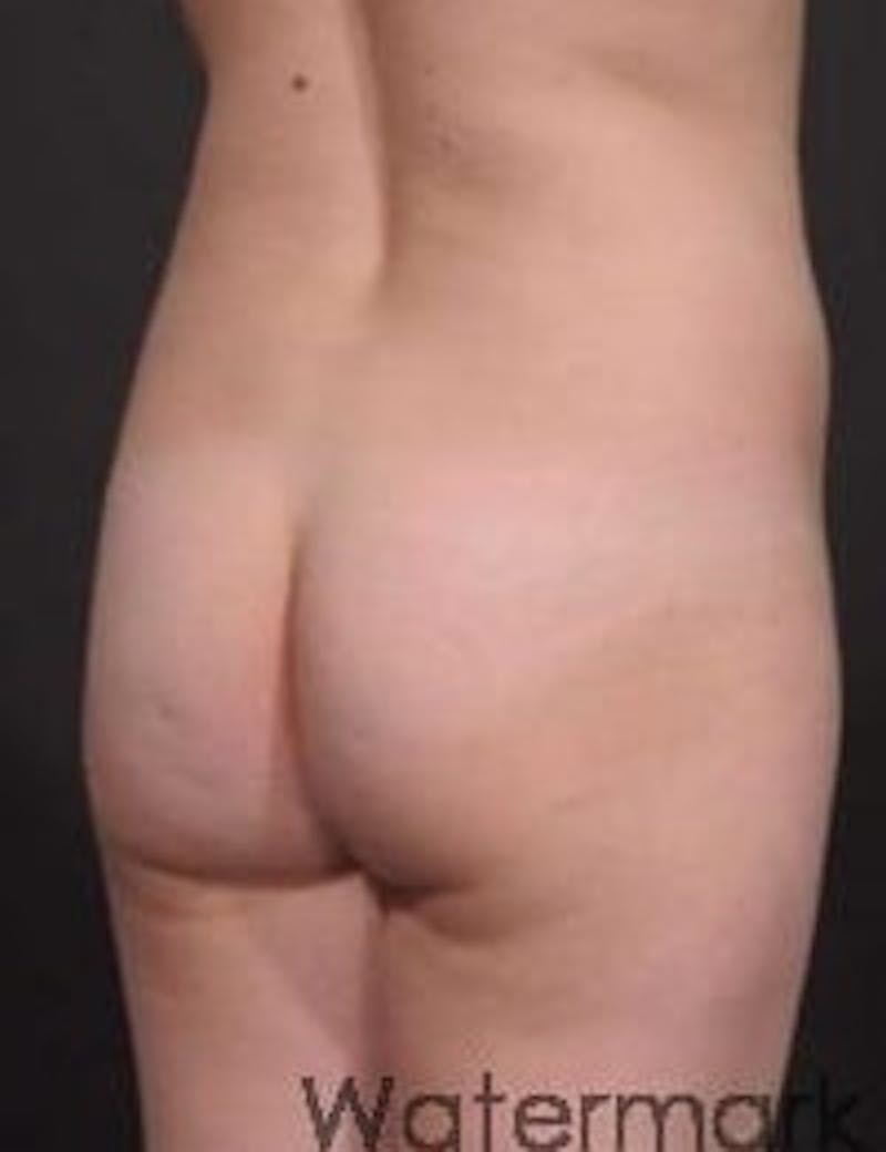 Brazilian Butt Augmentation Before & After Gallery - Patient 206680 - Image 1