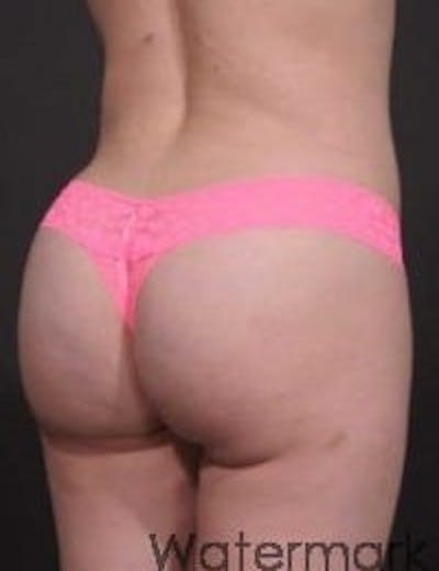 Brazilian Butt Augmentation Before & After Gallery - Patient 206680 - Image 2