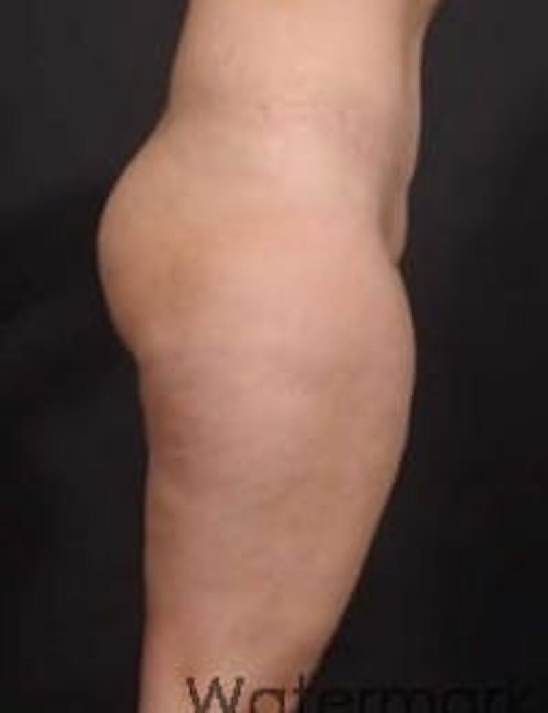 Brazilian Butt Augmentation Before & After Gallery - Patient 266666 - Image 1