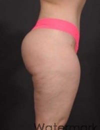 Brazilian Butt Augmentation Before & After Gallery - Patient 266666 - Image 2