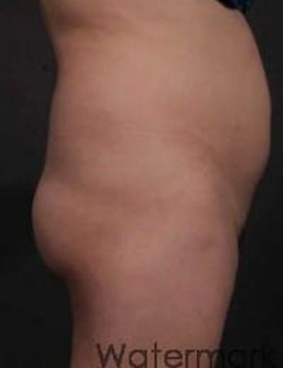 Brazilian Butt Augmentation Before & After Gallery - Patient 101109 - Image 1