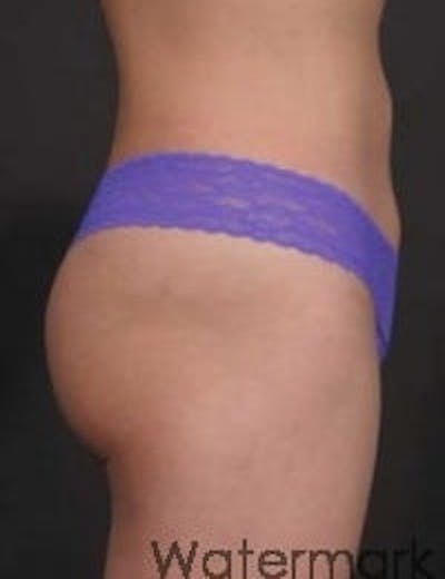 Brazilian Butt Augmentation Before & After Gallery - Patient 101109 - Image 2