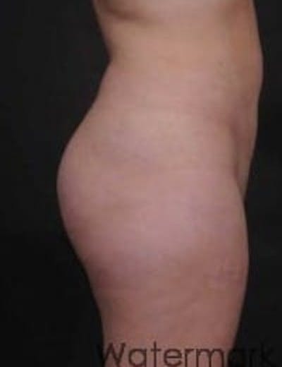 Brazilian Butt Augmentation Before & After Gallery - Patient 103465 - Image 1