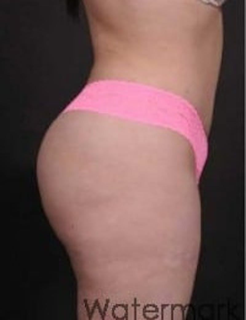 Brazilian Butt Augmentation Before & After Gallery - Patient 103465 - Image 2