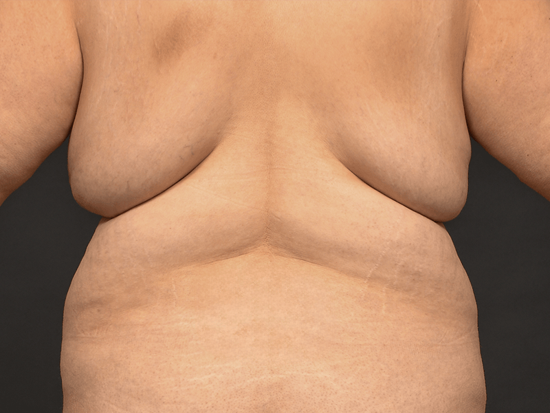 Back Lift Before & After Gallery - Patient 251218 - Image 1