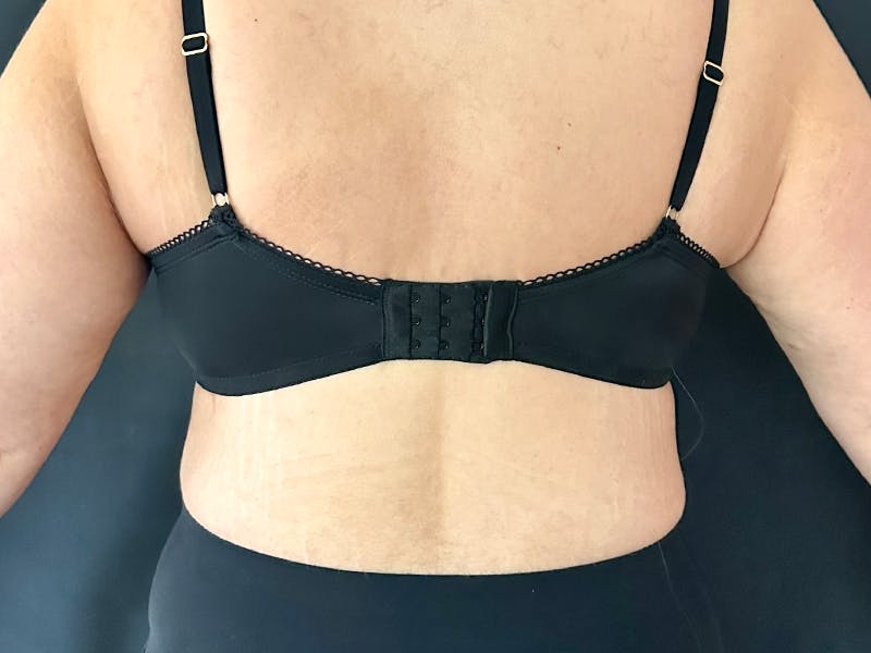 Back Lift Before & After Gallery - Patient 251218 - Image 2