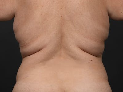 Back Lift Before & After Gallery - Patient 298050 - Image 1