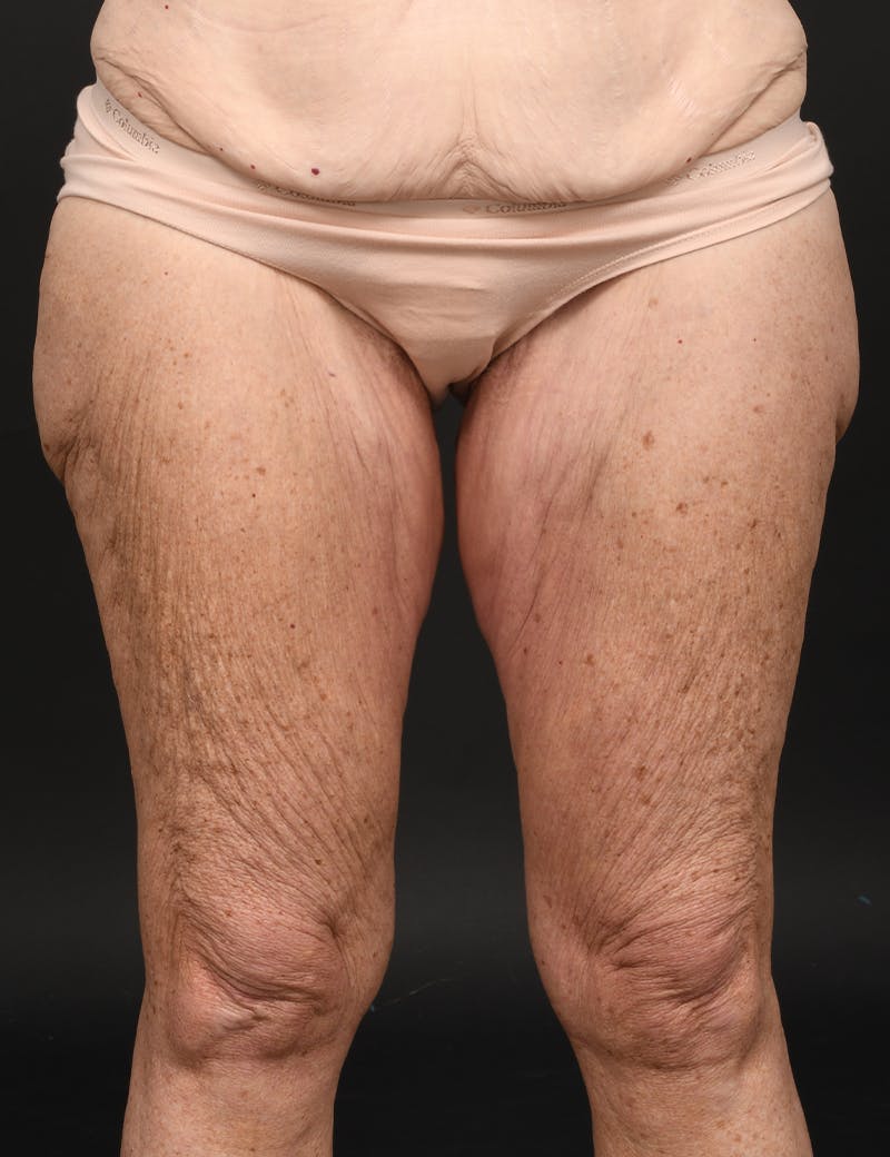 Thigh Lift Before & After Gallery - Patient 134532 - Image 1