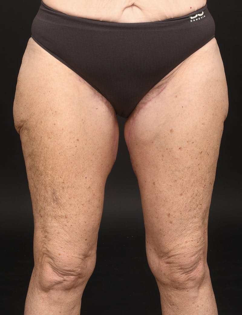 Thigh Lift Before & After Gallery - Patient 134532 - Image 2