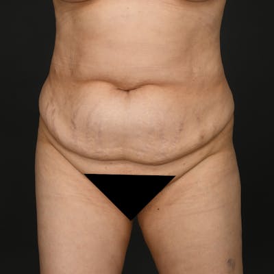Liposuction Before & After Gallery - Patient 259662 - Image 1