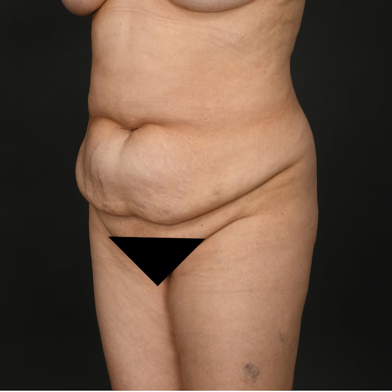 Liposuction Before & After Gallery - Patient 259662 - Image 3