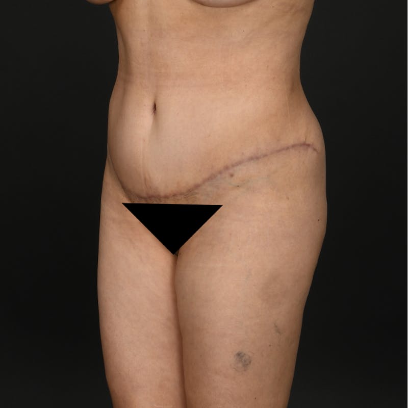 Liposuction Before & After Gallery - Patient 259662 - Image 4