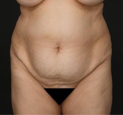 Liposuction Before & After Gallery - Patient 162446 - Image 1