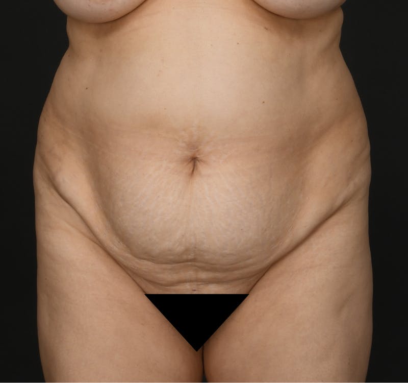 Liposuction Before & After Gallery - Patient 162446 - Image 1