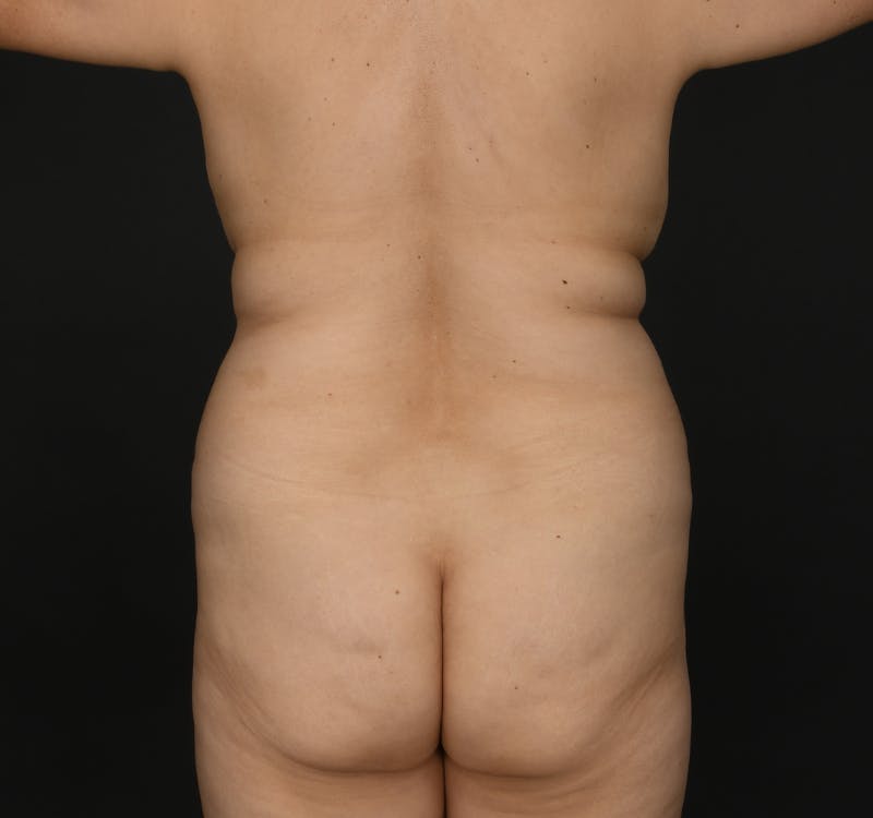 Liposuction Before & After Gallery - Patient 162446 - Image 5