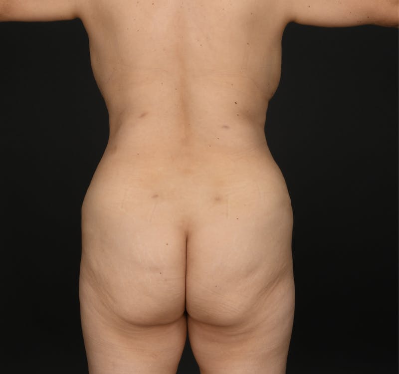 Liposuction Before & After Gallery - Patient 162446 - Image 6
