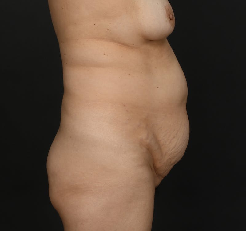 Liposuction Before & After Gallery - Patient 162446 - Image 7