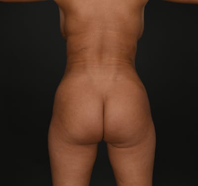 Liposuction Before & After Gallery - Patient 256538 - Image 2