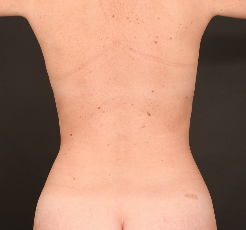 Liposuction Before & After Gallery - Patient 224646 - Image 7