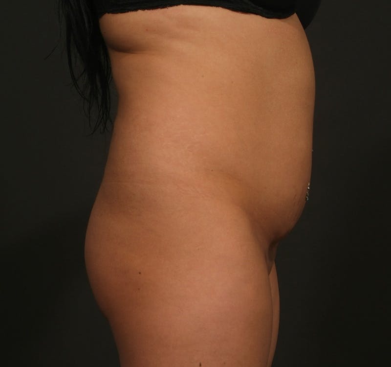 Liposuction Before & After Gallery - Patient 123071 - Image 5