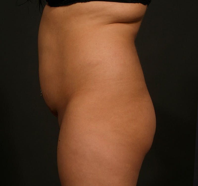 Liposuction Before & After Gallery - Patient 123071 - Image 7