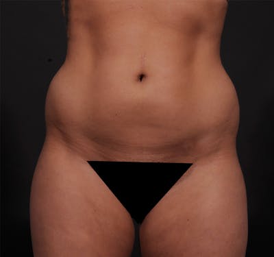Liposuction Before & After Gallery - Patient 271964 - Image 1