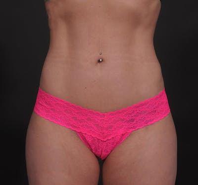 Liposuction Before & After Gallery - Patient 271964 - Image 2