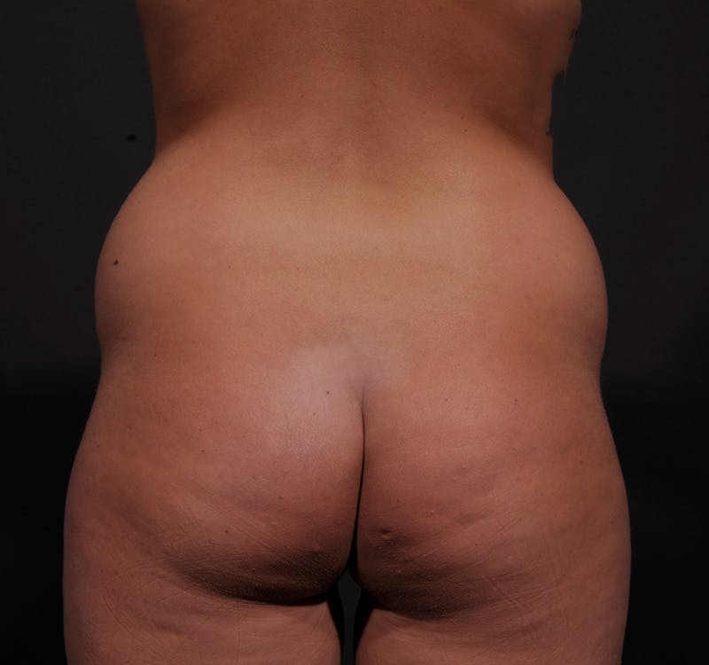 Liposuction Before & After Gallery - Patient 271964 - Image 7