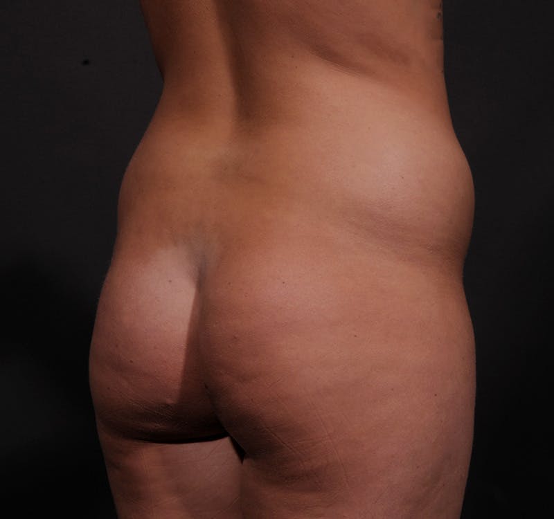 Liposuction Before & After Gallery - Patient 271964 - Image 9