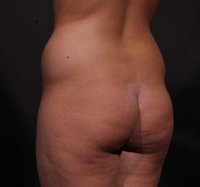 Liposuction Before & After Gallery - Patient 271964 - Image 11