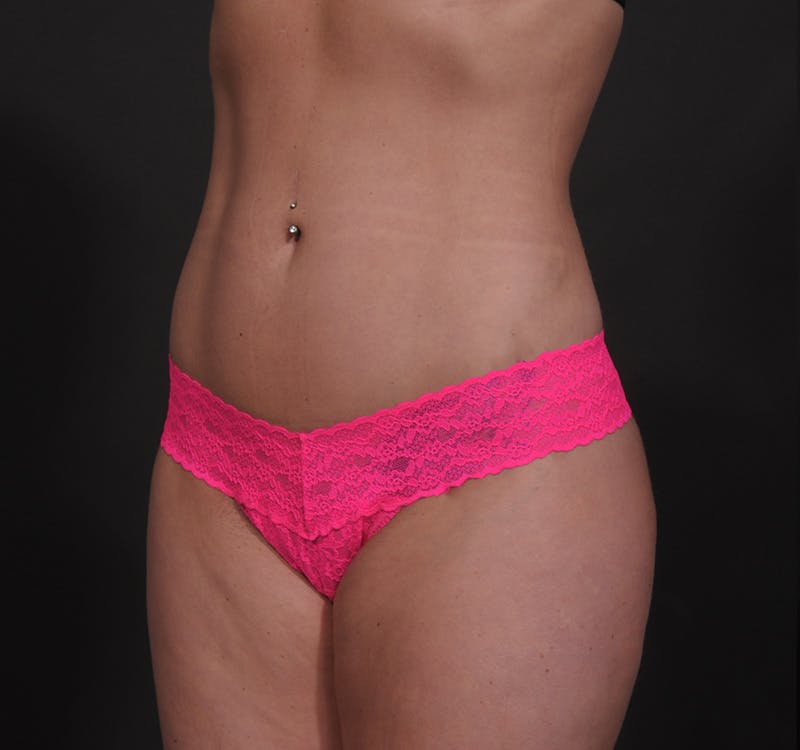 Liposuction Before & After Gallery - Patient 271964 - Image 16