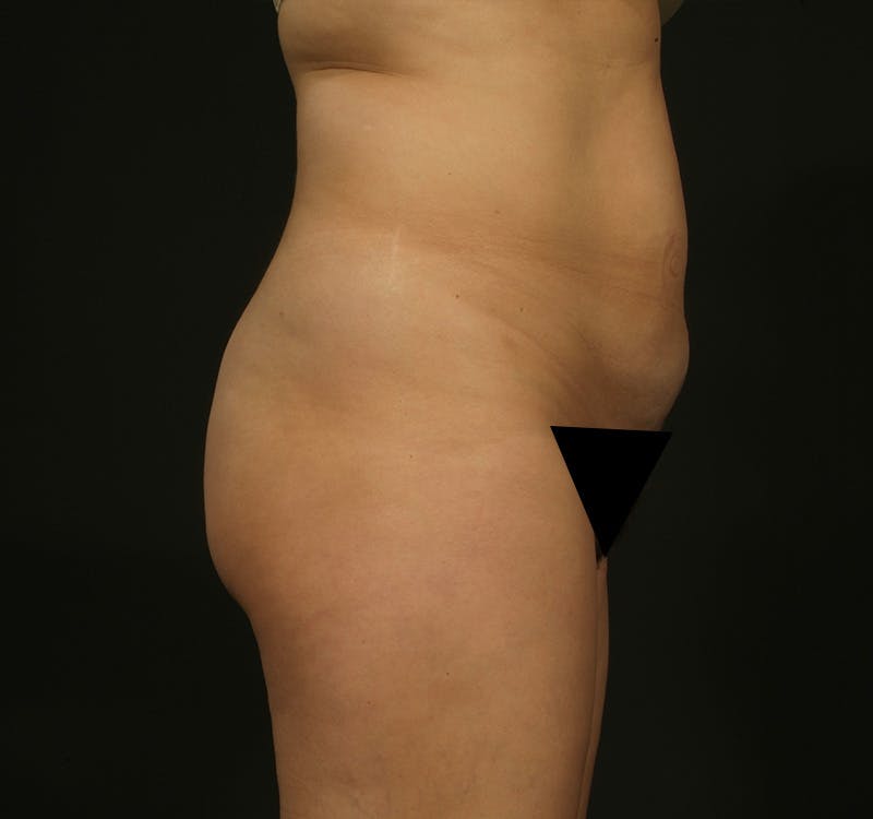 Liposuction Before & After Gallery - Patient 347763 - Image 5